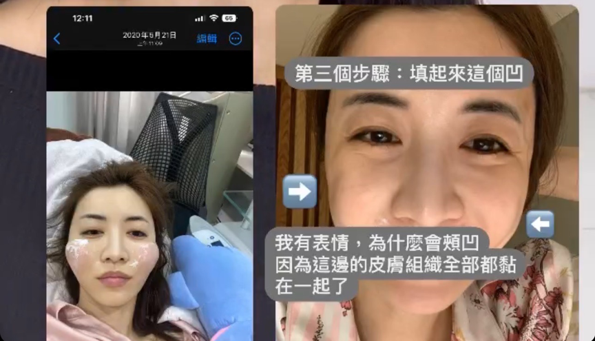 【我的真實醫美修復紀錄】選對醫生很重要！從點線面進行4D全臉矯正，我推薦梁仲斌醫生的全面性醫學美容治療