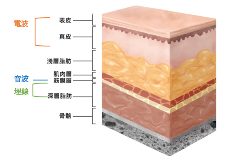 【抗老醫美評比】埋線、音波、電波哪種最適合妳？從原理、療效和適用對象對症下藥的拉提緊實醫美選擇全攻略