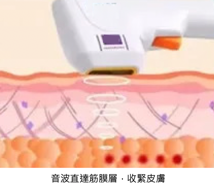 【抗老醫美評比】埋線、音波、電波哪種最適合妳？從原理、療效和適用對象對症下藥的拉提緊實醫美選擇全攻略