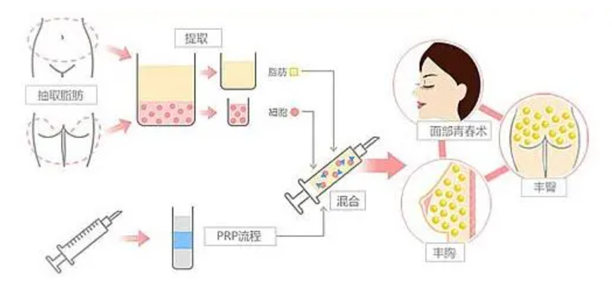 補充膠原蛋白的最棒的方式就是「自體生長膠原蛋白」，這與注射生長因子在肌膚真皮層有著密切的關聯，讓妳皮膚的細胞被重啟！