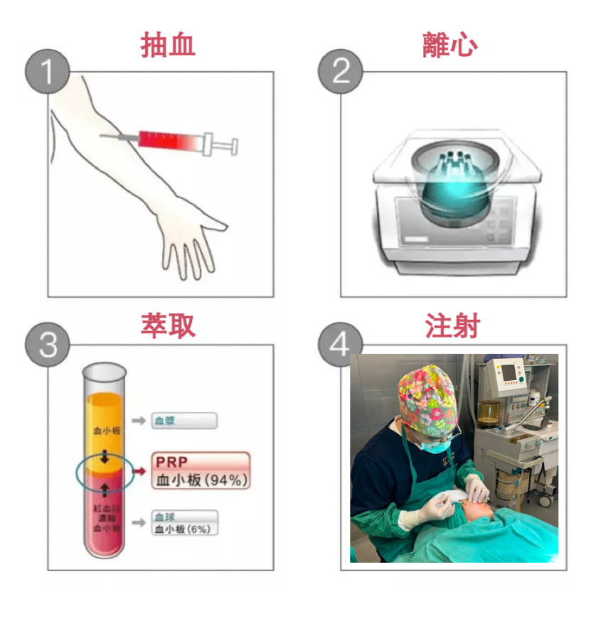 補充膠原蛋白的最棒的方式就是「自體生長膠原蛋白」，這與注射生長因子在肌膚真皮層有著密切的關聯，讓妳皮膚的細胞被重啟！