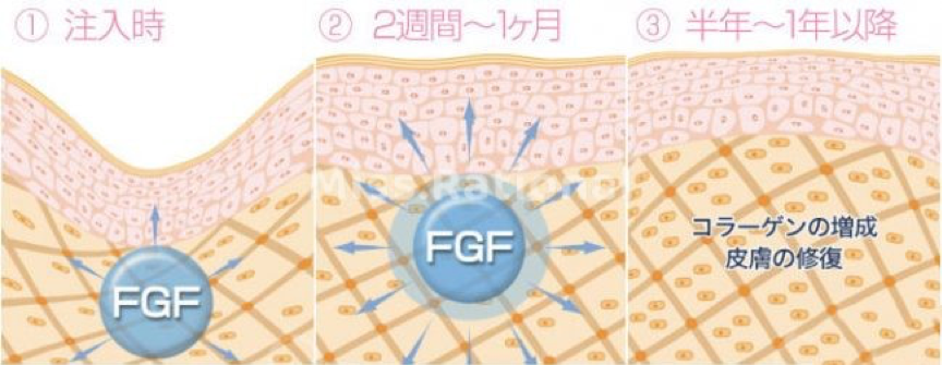 補充膠原蛋白的最棒的方式就是「自體生長膠原蛋白」，這與注射生長因子在肌膚真皮層有著密切的關聯，讓妳皮膚的細胞被重啟！