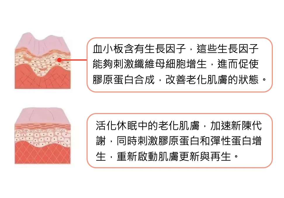 補充膠原蛋白的最棒的方式就是「自體生長膠原蛋白」，這與注射生長因子在肌膚真皮層有著密切的關聯，讓妳皮膚的細胞被重啟！