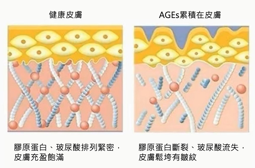 臉垂、皺紋多、粉刺痘痘長不停，都是因為妳有「糖化臉」！皮膚過糖化造成的10大問題