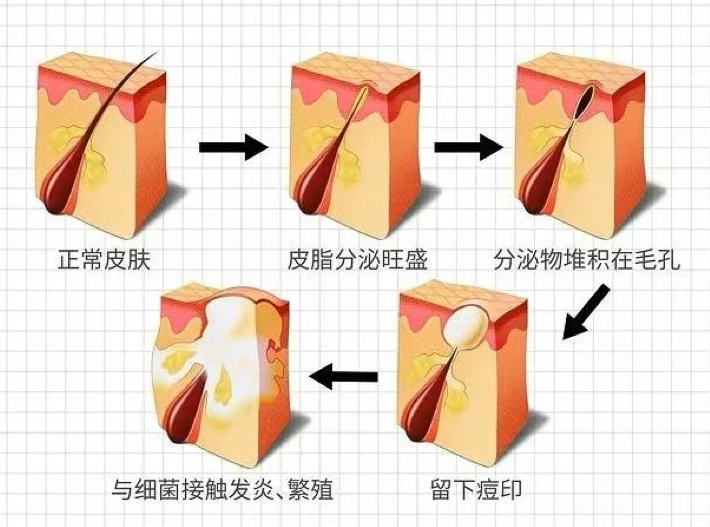 臉垂、皺紋多、粉刺痘痘長不停，都是因為妳有「糖化臉」！皮膚過糖化造成的10大問題