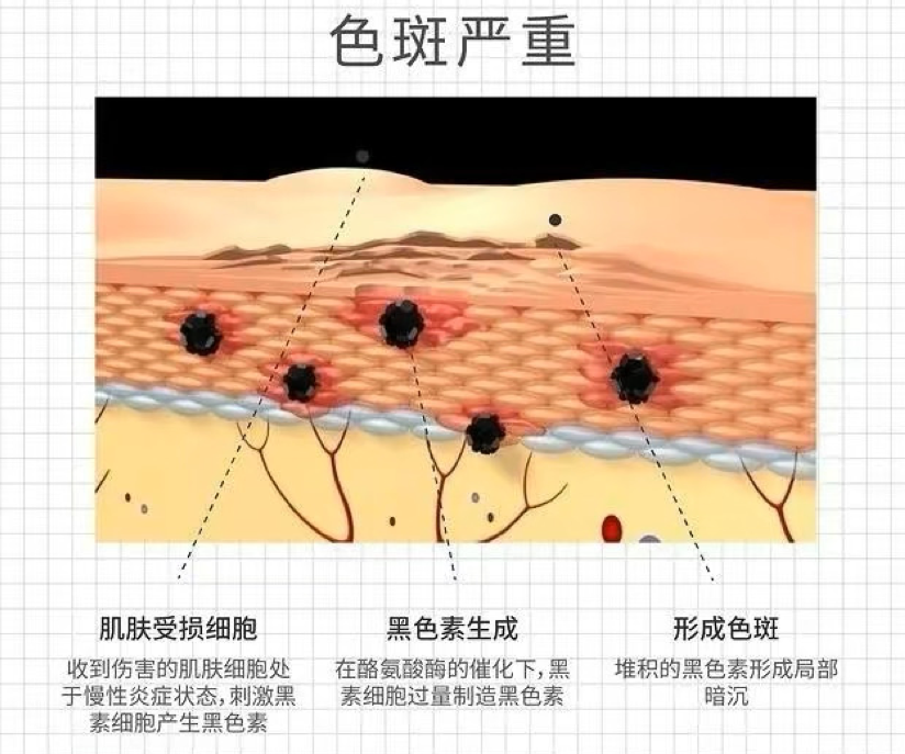 臉垂、皺紋多、粉刺痘痘長不停，都是因為妳有「糖化臉」！皮膚過糖化造成的10大問題