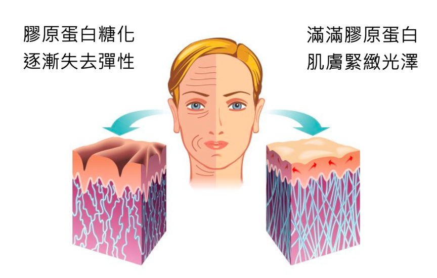 臉垂、皺紋多、粉刺痘痘長不停，都是因為妳有「糖化臉」！皮膚過糖化造成的10大問題