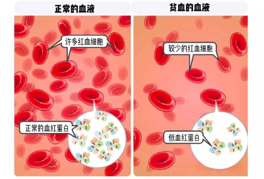 瘦不下來是因為貧血？缺鐵症狀多！讓妳水腫難消、肥油堆積！全方位大補「鐵」優化代謝效率，啟動有效瘦身計畫